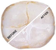 Sealants: Defense Against Tooth Decay