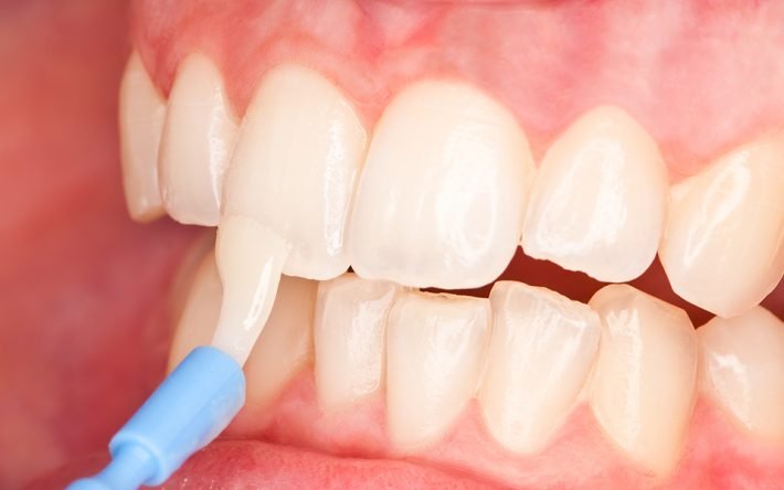 Fluoride