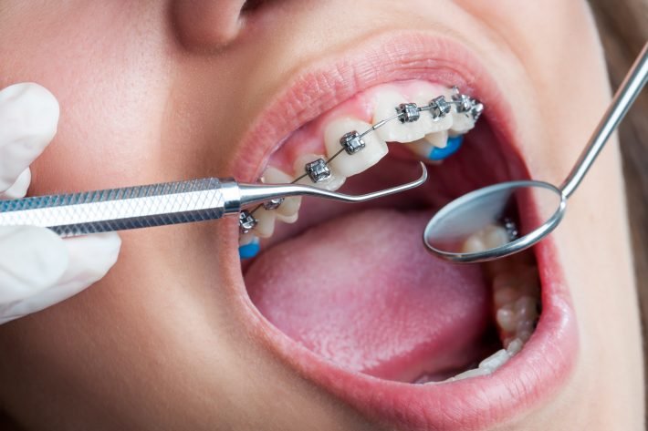 How Soon Should Your Child See the Orthodontist?