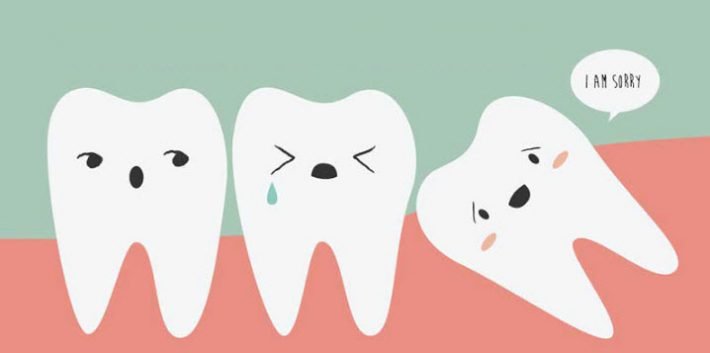 Wisdom Teeth Removal