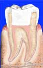root-canal-6