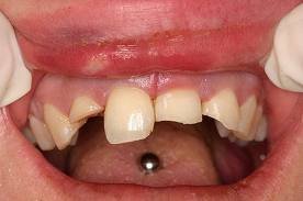 Risks of oral piercings - Clínica Pardiñas