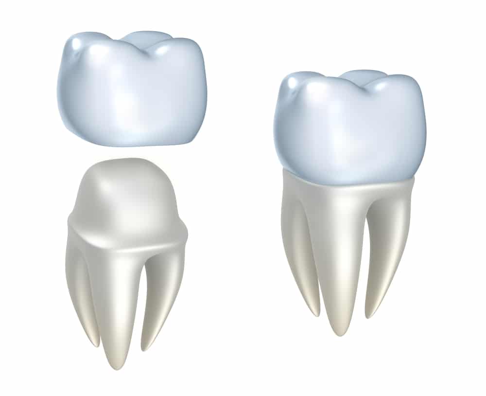 Dental-Crown-chalfont