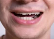 A Man with cracked tooth needs dental bonding raleigh