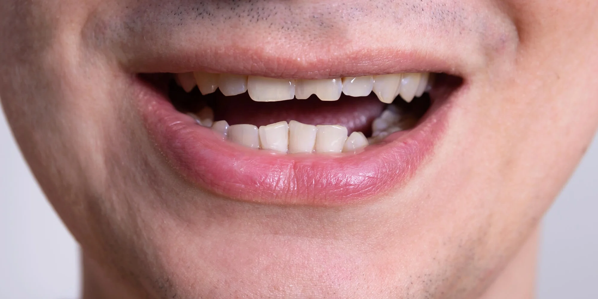 A Man with cracked tooth needs dental bonding raleigh