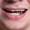 A Man with cracked tooth needs dental bonding raleigh