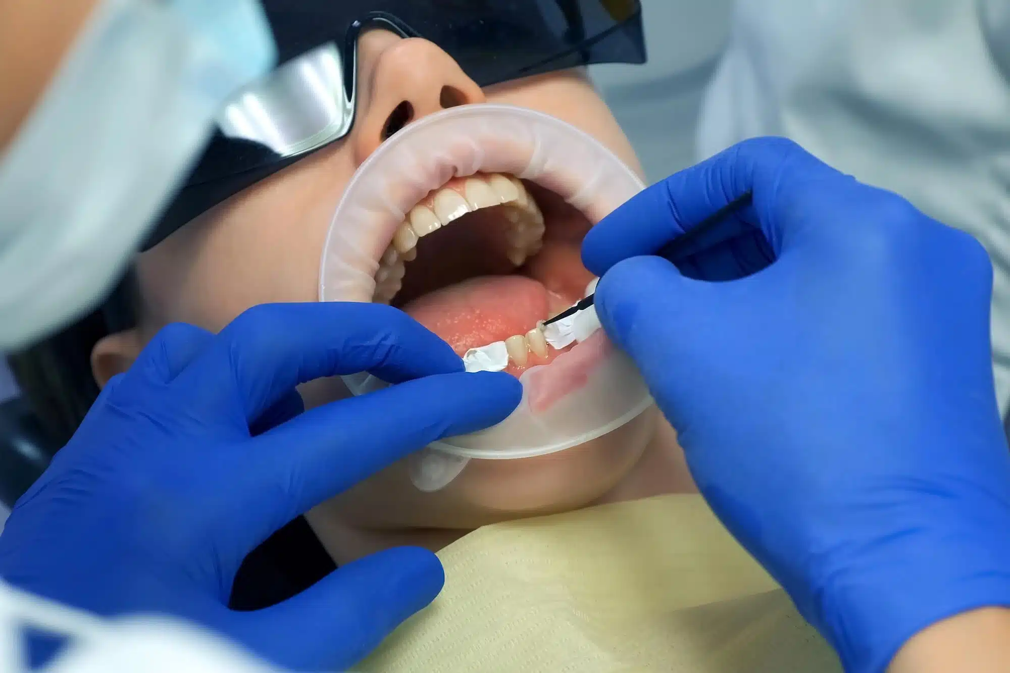 Dentist putting veneers raleigh nc