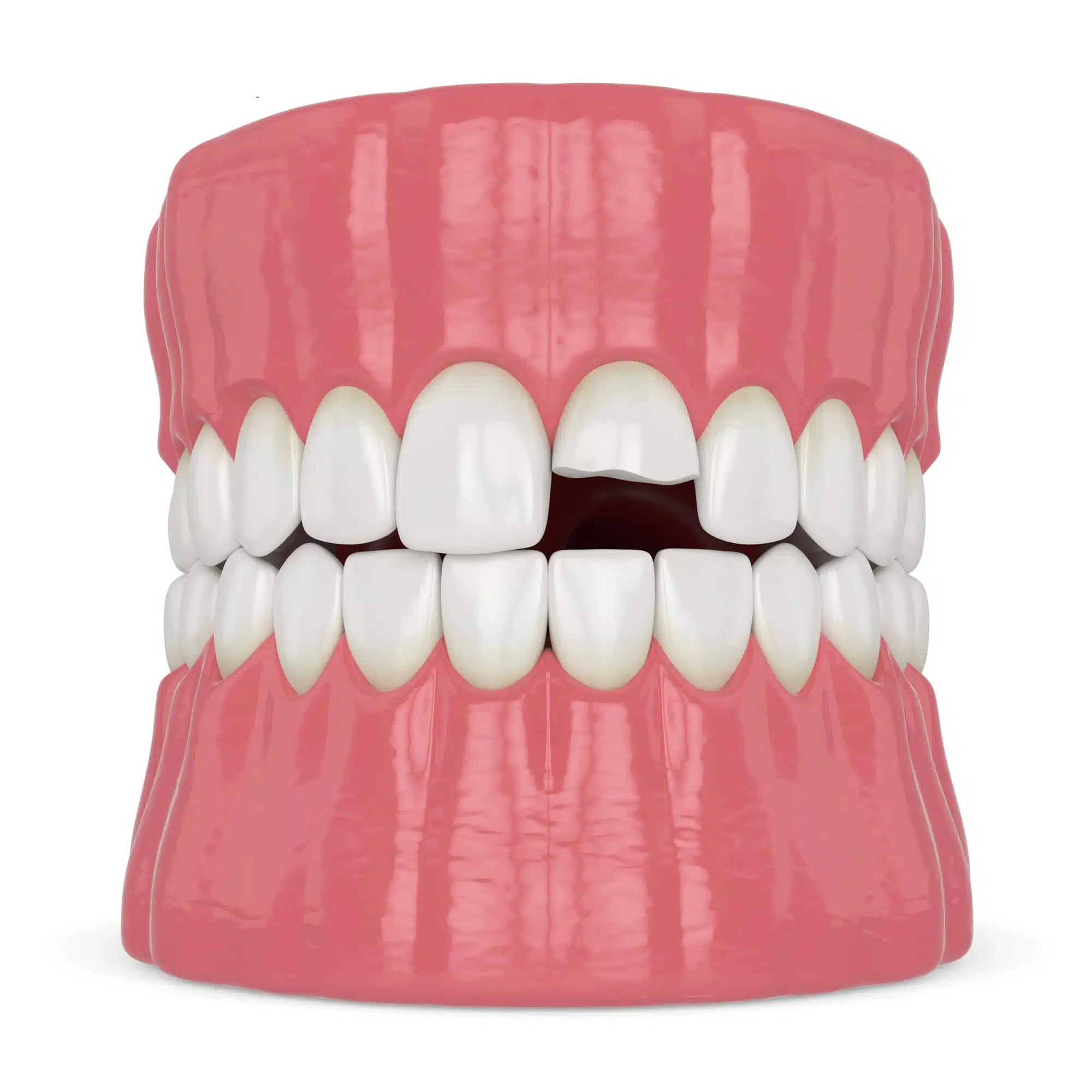 Cracked tooth needs emergency dentist raleigh nc