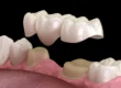 3D illustration of dental bridges raleigh