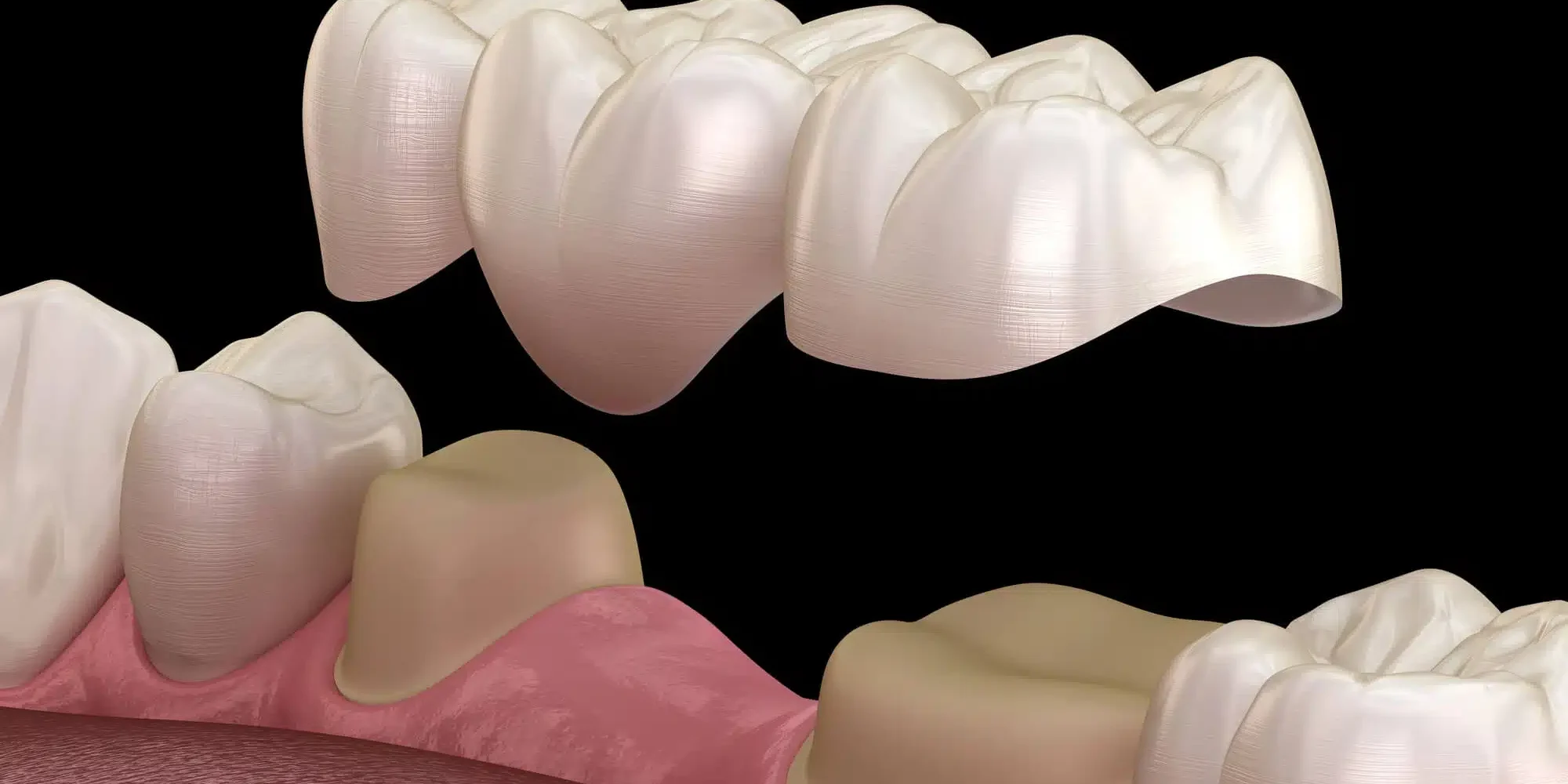 3D illustration of dental bridges raleigh