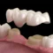3D illustration of dental bridges raleigh