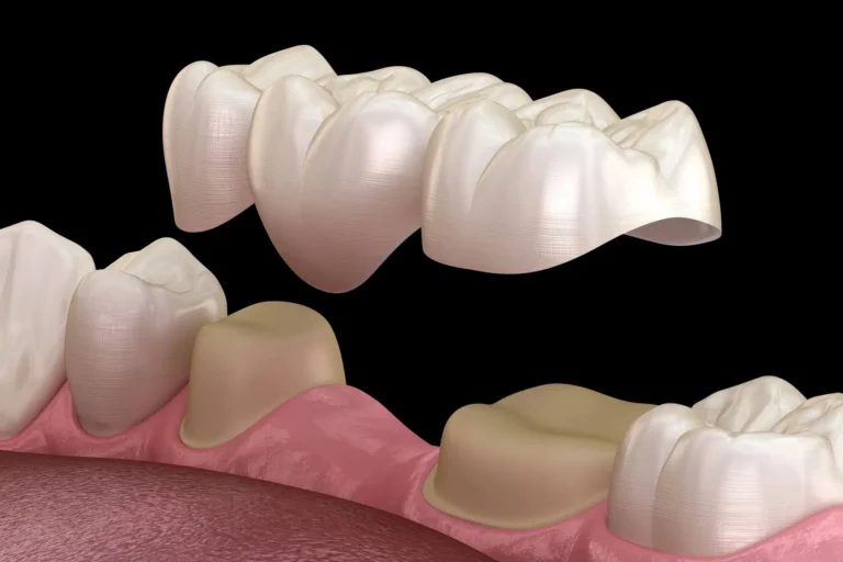 3D illustration of dental bridges raleigh