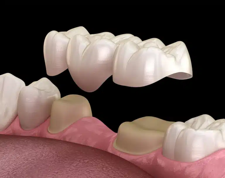 3D illustration of dental bridges raleigh