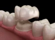 3D-illustration-of-dental-crowns-raleigh