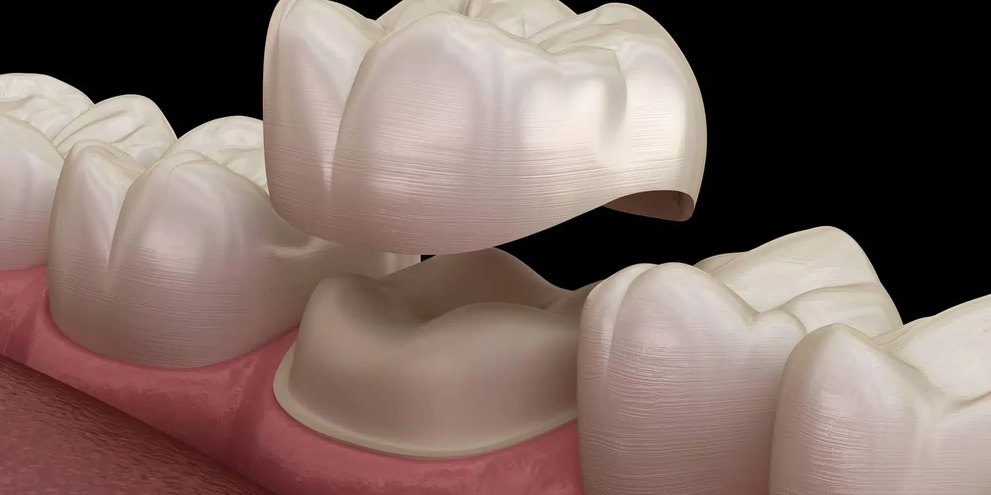 3D illustration of dental crowns raleigh 3D-illustration-of-dental-crowns-raleigh