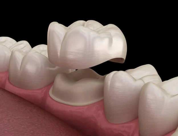 3D illustration of dental crowns raleigh 3D-illustration-of-dental-crowns-raleigh