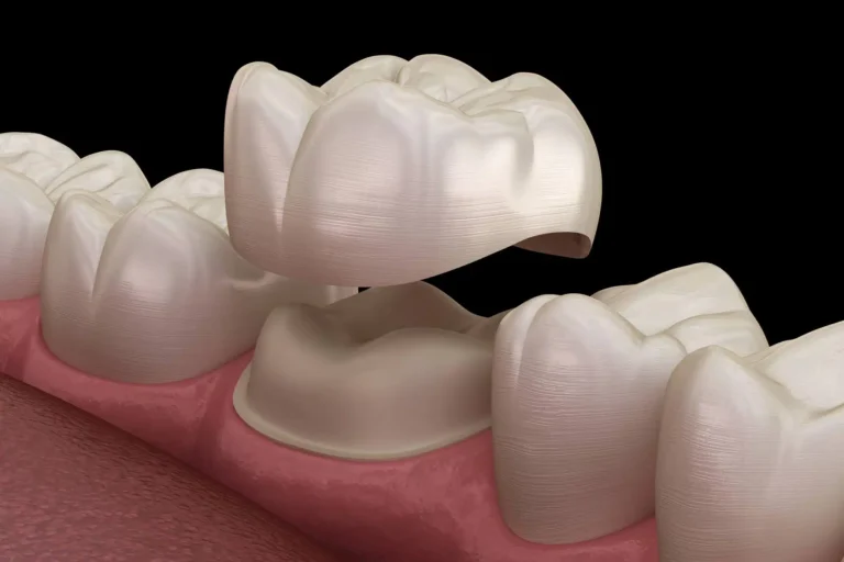3D-illustration-of-dental-crowns-raleigh