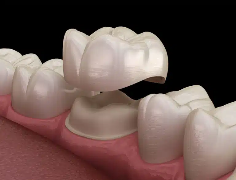 3D-illustration-of-dental-crowns-raleigh