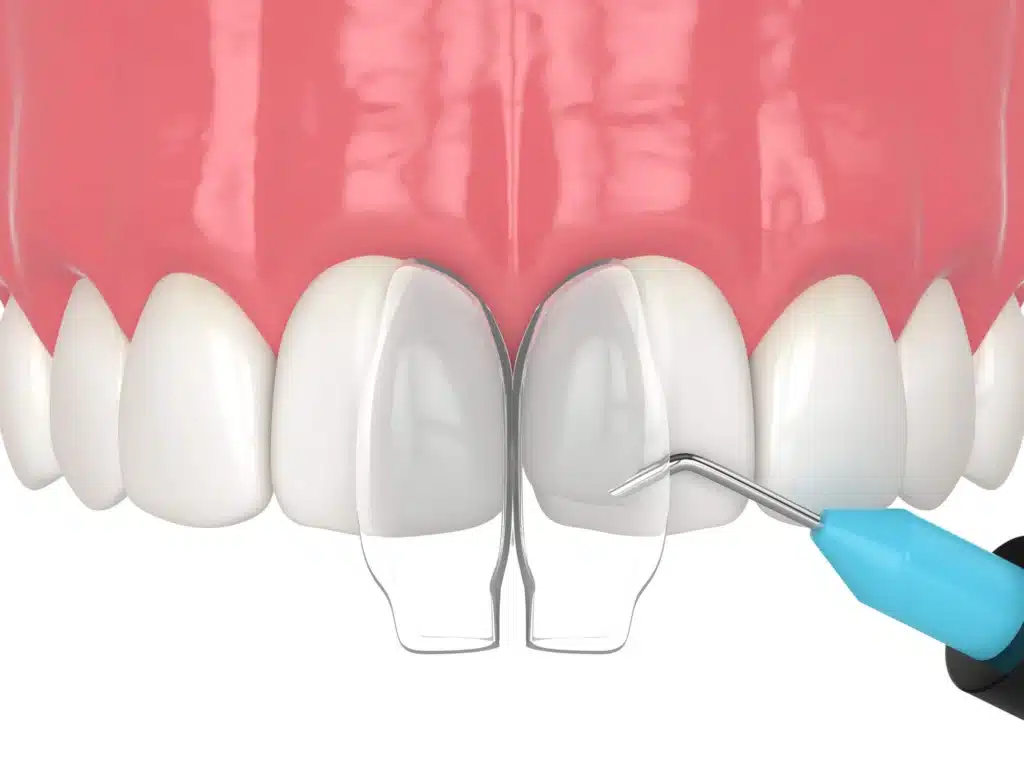 dental-bonding-raleigh